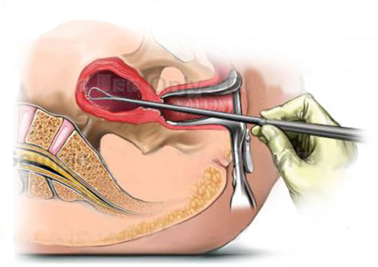 Endometrial Biopsy